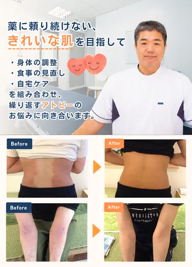 アトピー改善プログラム