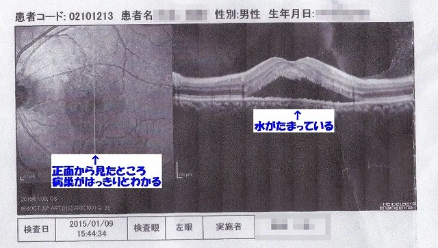 札幌市東区みらくる整体院 CSC症例 MST治療開始頃の網膜写真