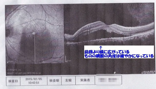 札幌市東区みらくる整体院 CSC症例 MST治療開始1か月後の網膜写真
