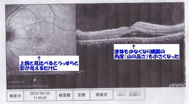 札幌市東区みらくる整体院 CSC症例 MST治療開始5か月後の網膜写真