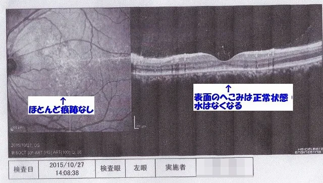 MST治療開始9か月後の網膜写真